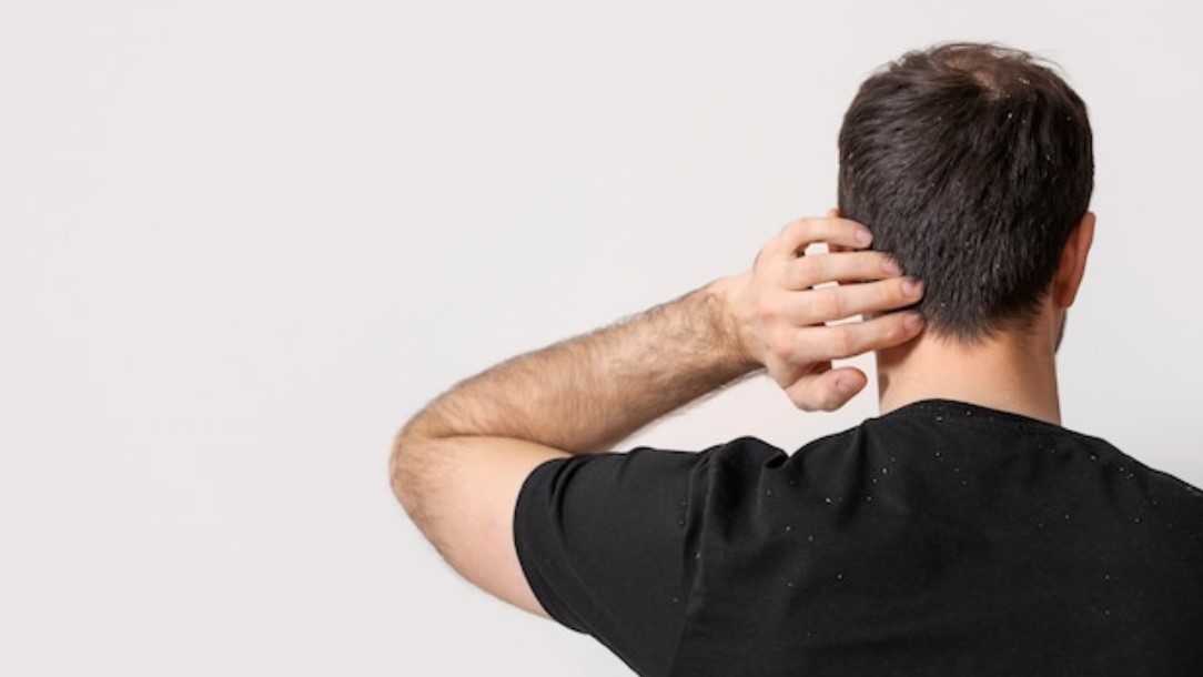 How To Treat Dandruff Mentor Pro